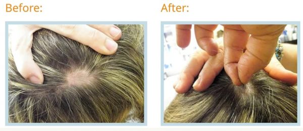 Alopecia Areata Treatment, Medicinal Herb, Shampoo, Lotion, Solution